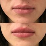 close-up of women's lips before and after lip filler injections