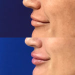 Before and after woman's injection of dermal fillers to enhance lips