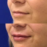 Before and after woman's injection of dermal fillers to enhance lips