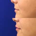 Before and after woman's injection of dermal fillers to enhance lips