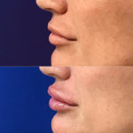 Before and after woman's injection of dermal fillers to enhance lips