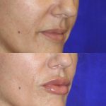 woman's mouth before and after Injectable lip fillers at artemedica