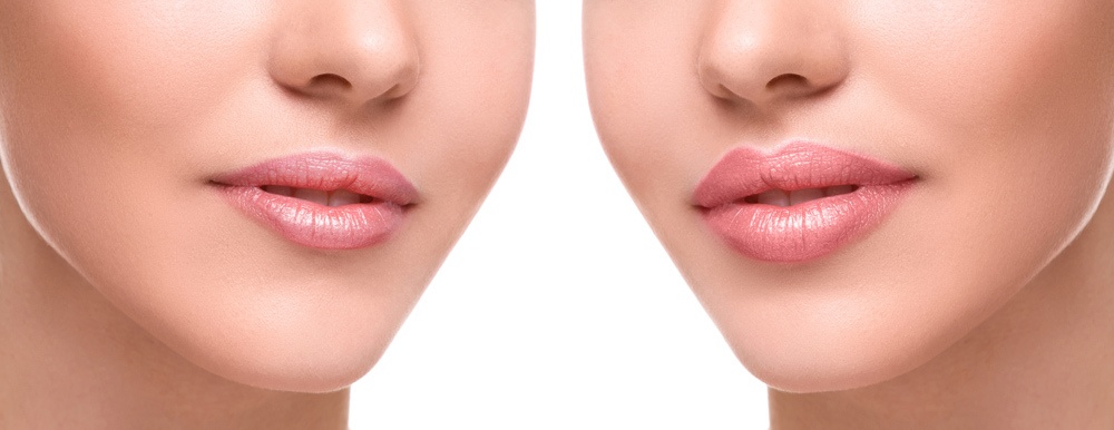before and after lip fillers