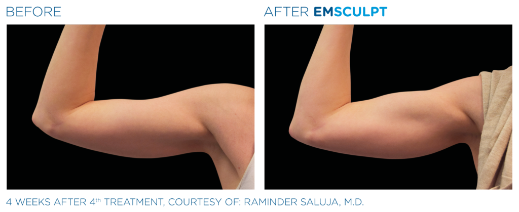before and after emsculpt photos of arms