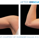 patient's arms before and after emsculpt showing improved definition and tone