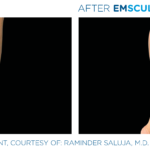 before and after emsculpt photos of calves