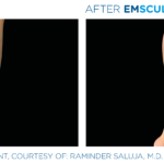 patient's calves before and after emsculpt showing improved tone