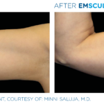 patient's biceps before and after emsculpt showing improved tone