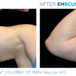 patient's biceps before and after emsculpt showing improved tone