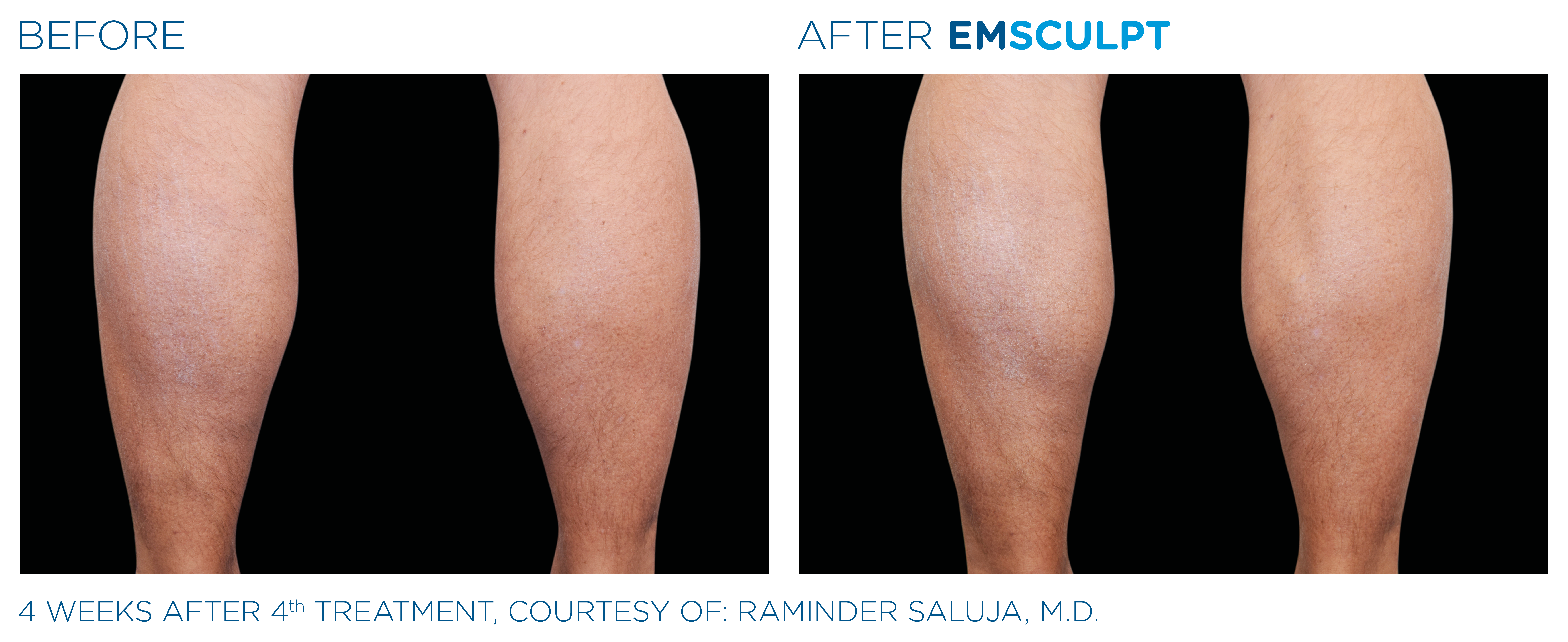 patient's calves before and after EmSculpt treatment showing improved definition and tone