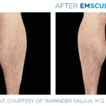 patient's calves before and after emsculpt showing improved tone