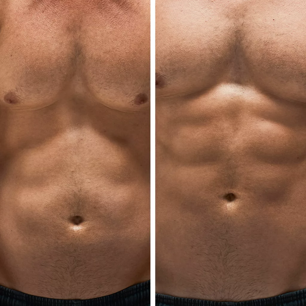 before and after emsculpt to tone, firm and strengthen muscles