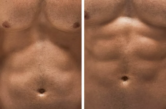 before and after emsculpt to tone, firm and strengthen muscles