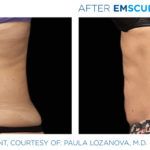 Before and after woman's EmSculpt treatment to reduce fat and encourage muscle growth