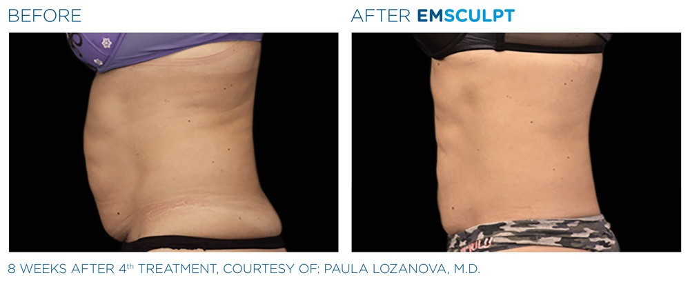 Before and after woman's EmSculpt treatment to reduce fat and encourage muscle growth