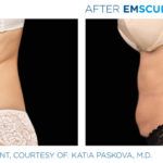 Before and after woman's EmSculpt treatment to reduce fat and encourage muscle growth