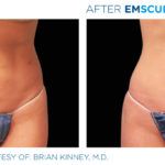 Before and after woman's EmSculpt treatment to reduce fat and encourage muscle growth