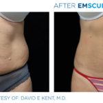 Before and after woman's EmSculpt treatment to reduce fat and encourage muscle growth