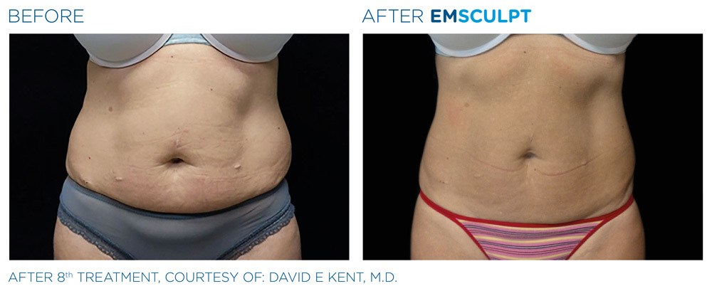 Before and after woman's EmSculpt treatment to reduce fat and encourage muscle growth