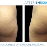 Before and after woman's EmSculpt treatment to reduce fat and encourage muscle growth