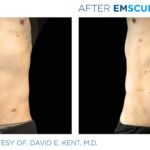 Before and after man's EmSculpt treatment to reduce fat and encourage muscle growth