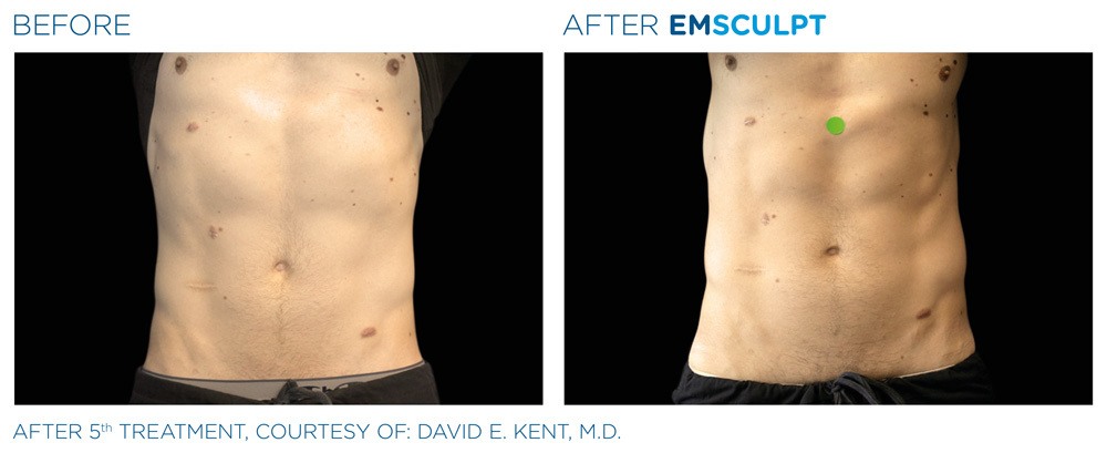 Before and after man's EmSculpt treatment to reduce fat and encourage muscle growth