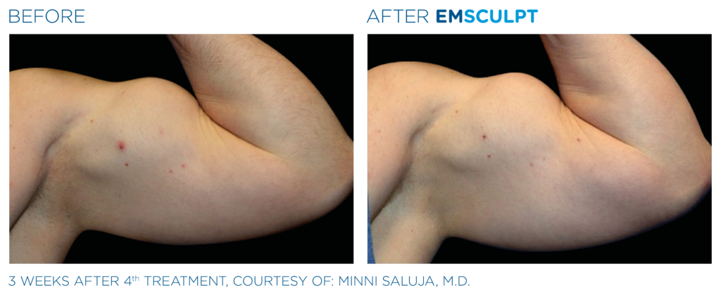 Before and after man's EmSculpt treatment to reduce fat and encourage muscle growth