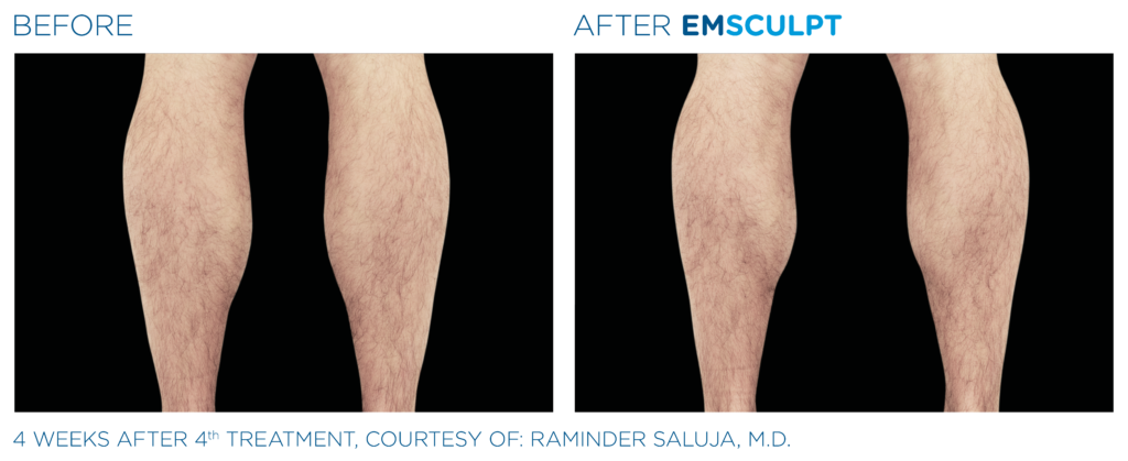 Before and after man's EmSculpt treatment to reduce fat and encourage muscle growth