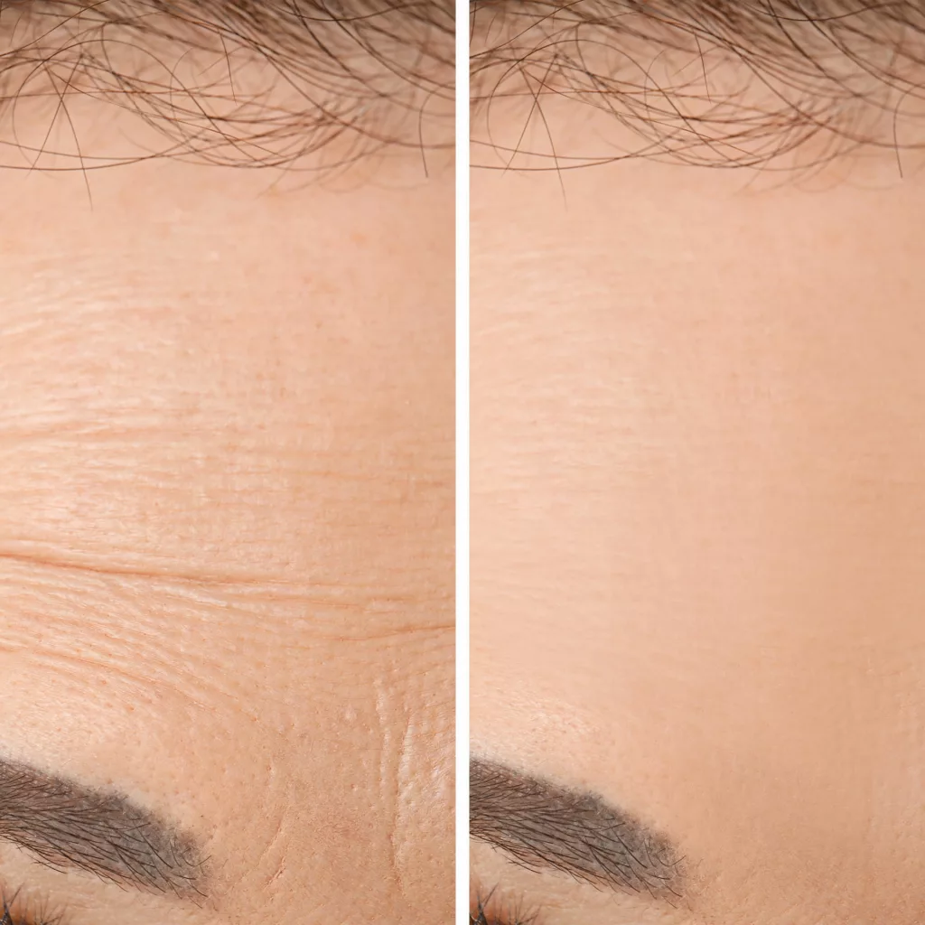 before and after dysport injections to address wrinkles between the eyebrows