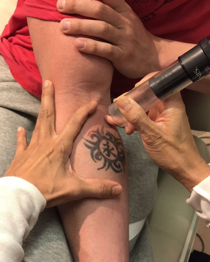 esthetician administering laser tattoo removal