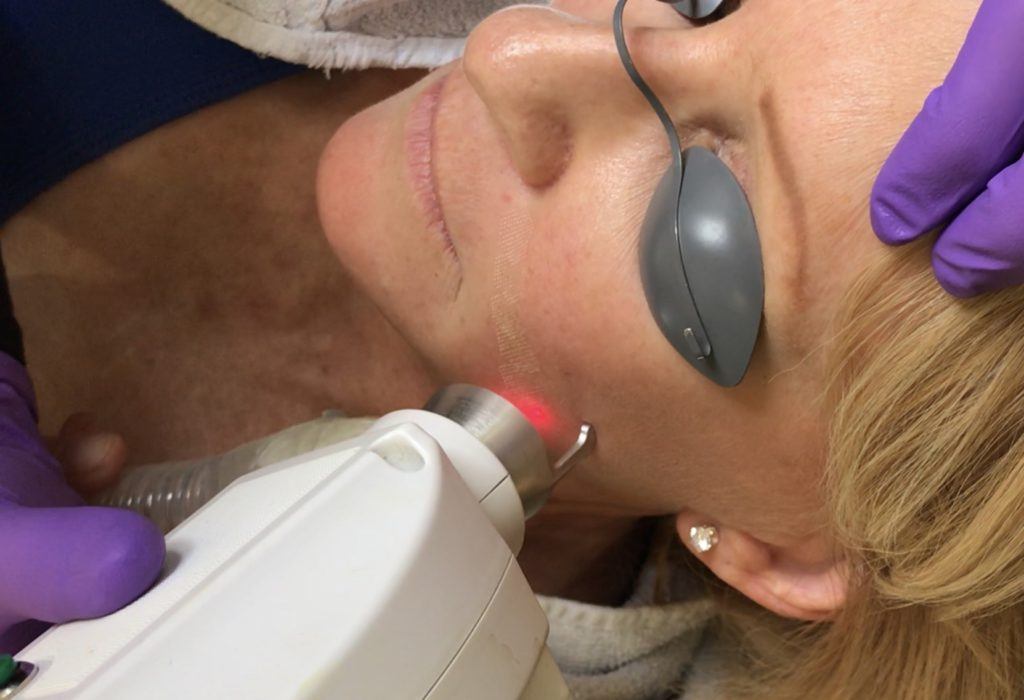 esthetician administering laser resurfacing treatment