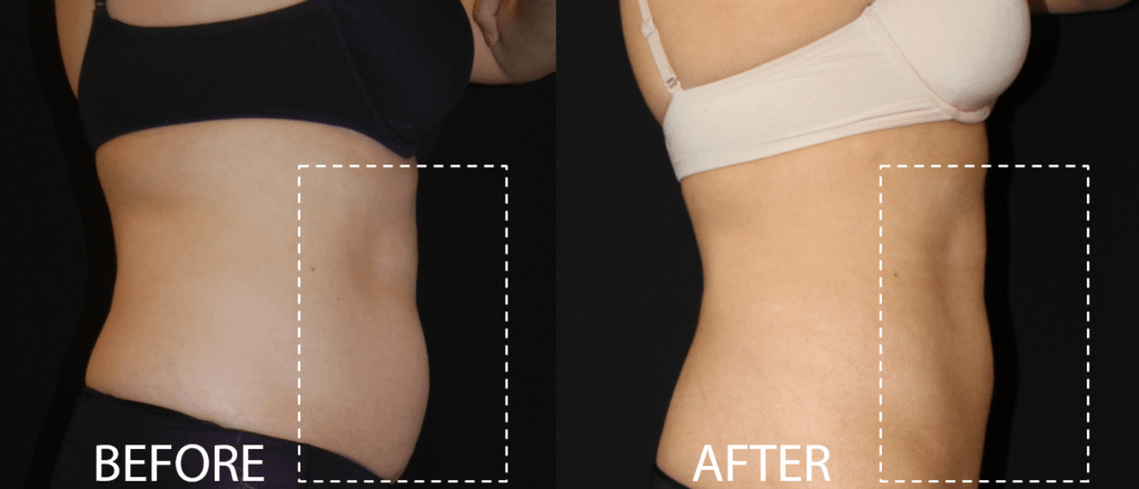 Before and after woman's CoolSculpting treatment to reduce fat and encourage muscle growth