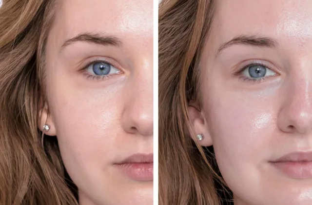 before and after professional microneedling treatment