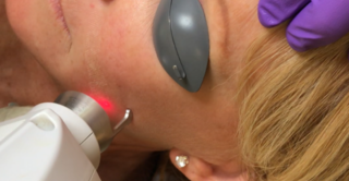Esthetician using laser facial treatment on client's cheek