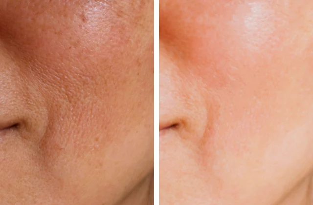 before and after Clear + Brilliant laser skin care treatment