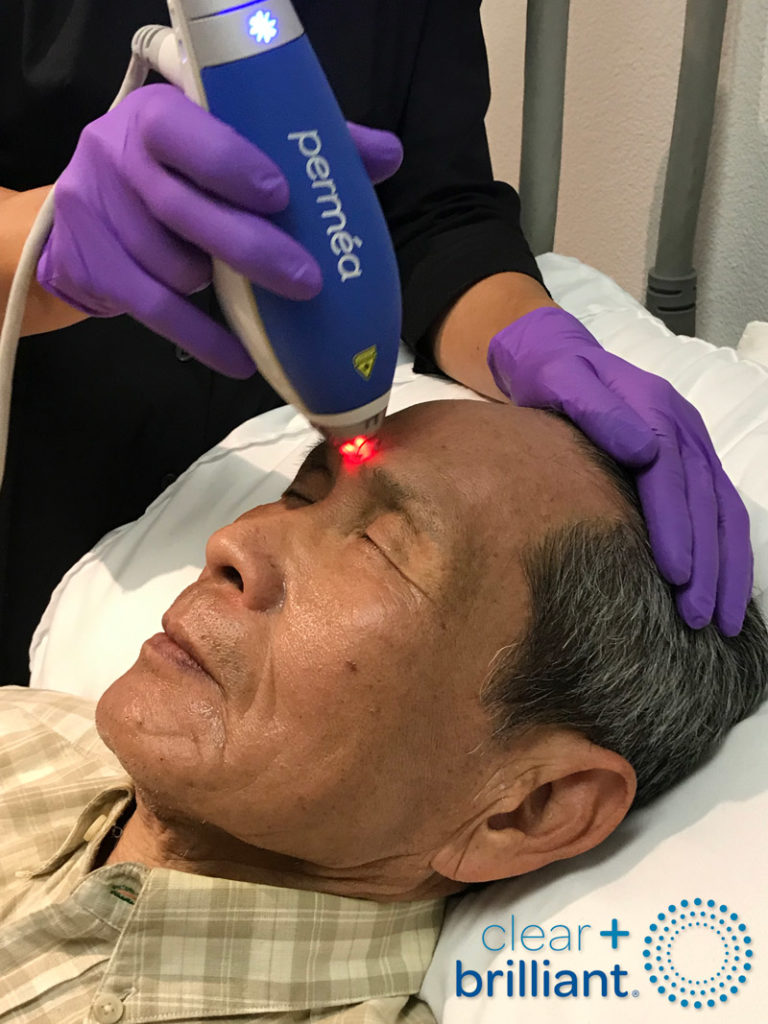 man receiving clear and brilliant laser skin resurfacing treatment