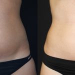Before and after woman's CoolTone treatment to reduce fat and encourage muscle growth