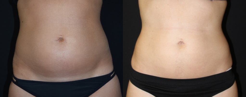 Before and after woman's CoolTone treatment to reduce fat and encourage muscle growth