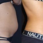 Before and after woman's CoolTone treatment to reduce fat and encourage muscle growth