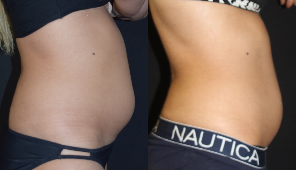 coolsculpting/cooltone before and after