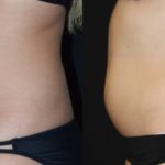 Before and after woman's CoolTone treatment to reduce fat and encourage muscle growth