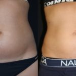 Before and after woman's CoolTone treatment to reduce fat and encourage muscle growth