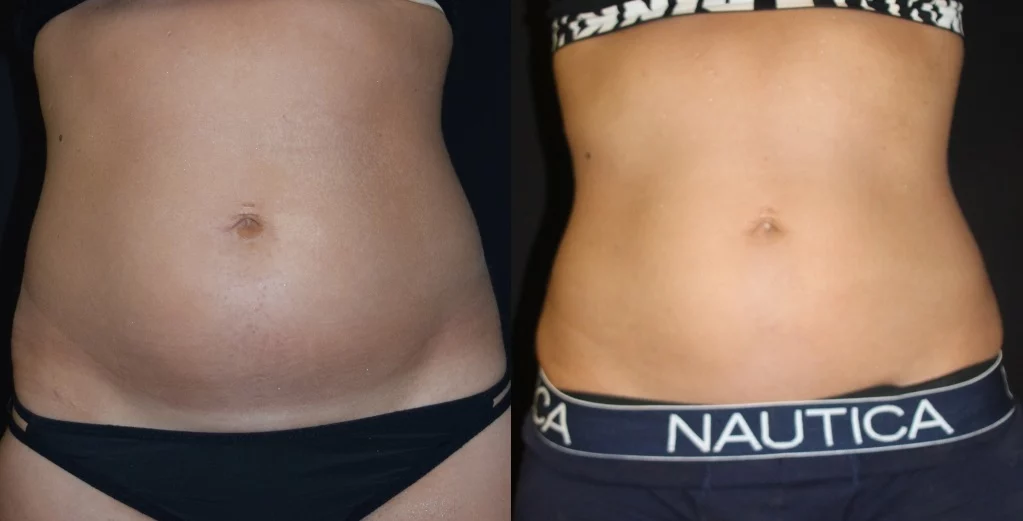 coolsculpting/cooltone before and after