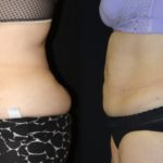 Before and after woman's CoolTone treatment to reduce fat and encourage muscle growth