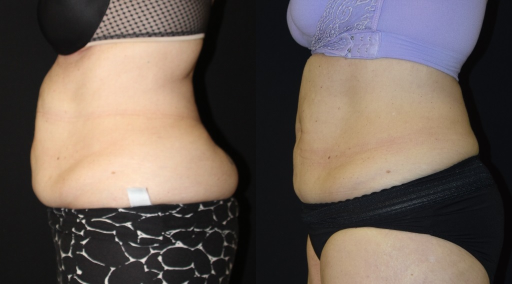 coolsculpting/cooltone before and after