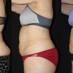 Before and after woman's CoolTone treatment to reduce fat and encourage muscle growth