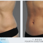 woman's abdomen before and after CoolTone treatment showing improved muscle tone