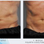 man's abdomen before and after CoolTone treatment showing improved muscle tone