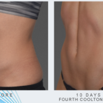 woman's abdomen before and after CoolTone treatment showing improved muscle tone