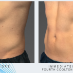 man's abdomen before and after CoolTone treatment showing improved muscle tone